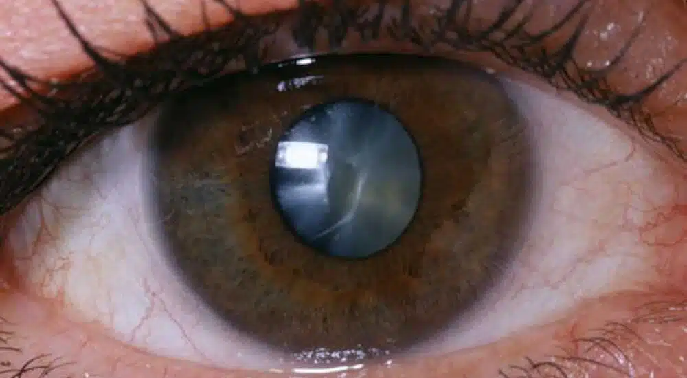 Cosa può comportare un intervento di cataratta? 1 Cosa può comportare un intervento di cataratta?